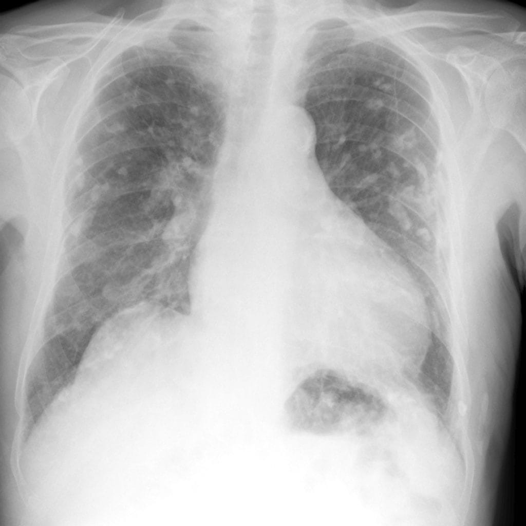 Why Radiologists Miss Diagnoses, and What It Means for Patients